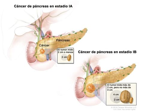 Tratamiento Del Cáncer De Páncreas Nci