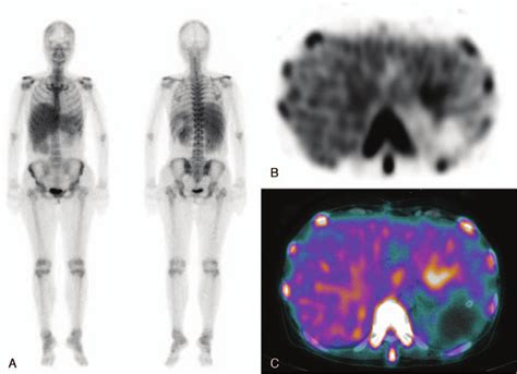 A Anterior And Posterior Whole Body M Tc Dpd Scan Images Of A