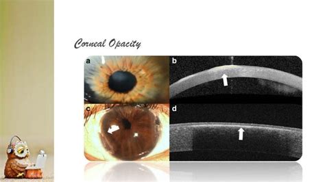 Anterior Segment OCT in Ophthalmology