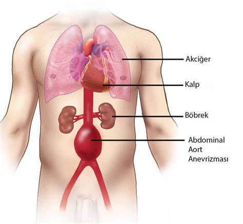 Abdominal Aort Anevrizması Prof Dr Levent OĞUZKURT