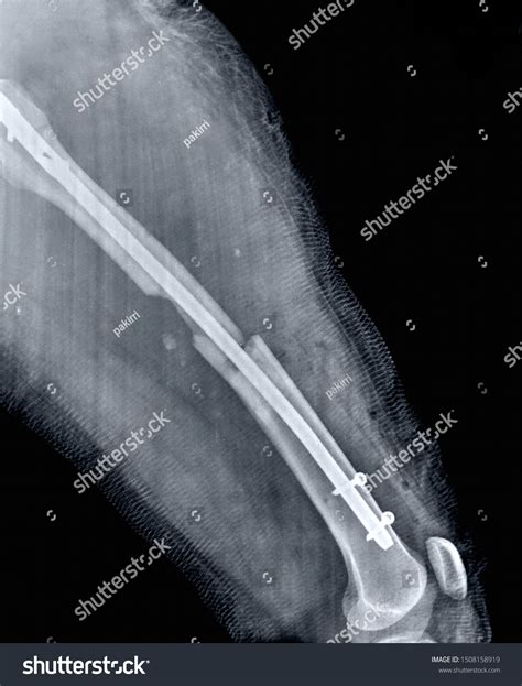 Hip Femur Fracture X Ray Stock Photo 1508158919 | Shutterstock