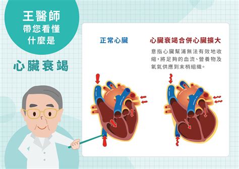 心臟衰竭 您不可不知的雙心疾病 王復蘇醫師官方網站