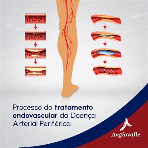 Processo de tratamento endovascular da Doença Arterial Periférica