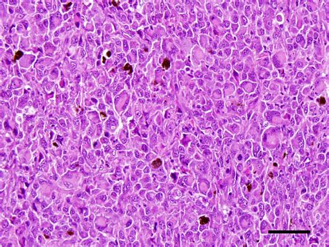 Neoplastic Round Cells In The Eye They Displayed Marked Anisocytosis
