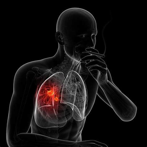 Lung Cancer Due To Smoking Photograph by Sciepro/science Photo Library ...