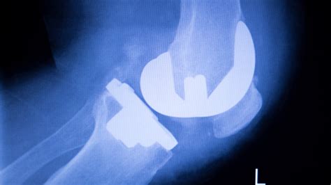 Robotic Knee Replacement Surgery The Future Of Joint