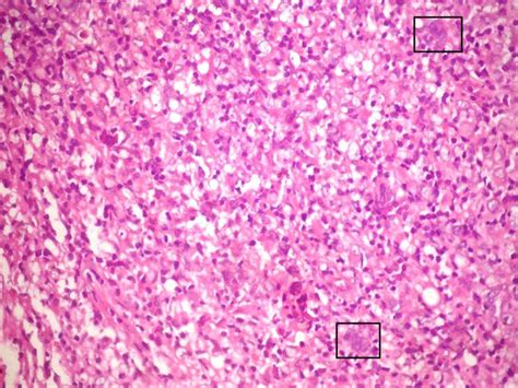 Pathology Outlines T Cell Histiocyte Rich