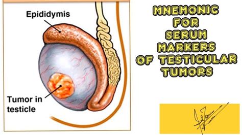 Mnemonic For Serum Markers Of Testicular Tumors Medicine With Dr