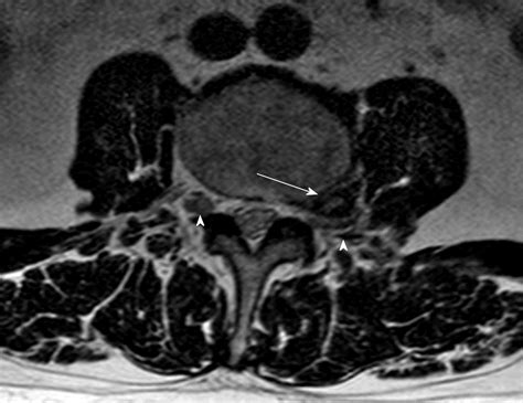 Lumbar Disc Herniation Mri