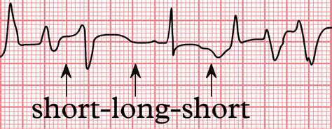 Torsades De Pointes Treatment Symptoms And Causes