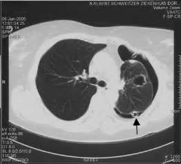 Arthritis Nodules On Lungs