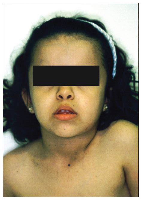 Basal Cell Nevus Syndrome