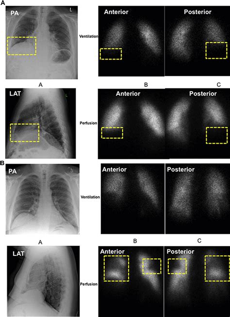 Hypoxic Pulmonary Vasoconstriction Chest