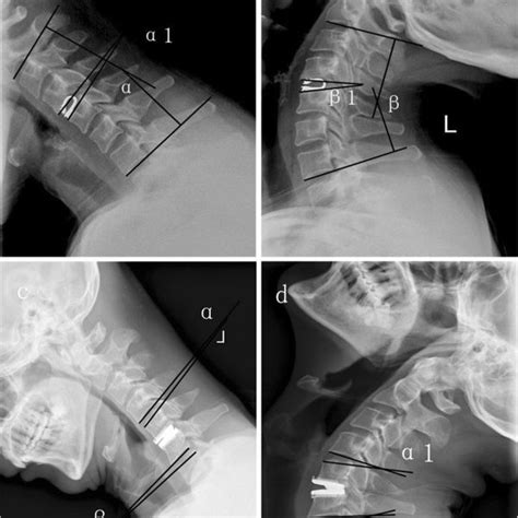 Hyperextension And Hyperflexion Radiograms Of Postoperative Dci And