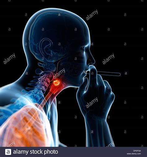 Larynx cancer, artwork Stock Photo - Alamy