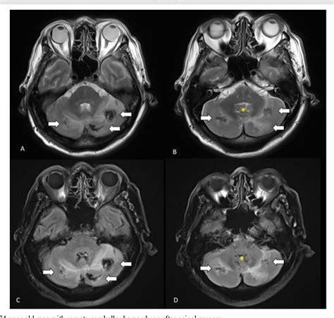 Figure From Remote Cerebellar Hemorrhage As A Complication Of Lumbar