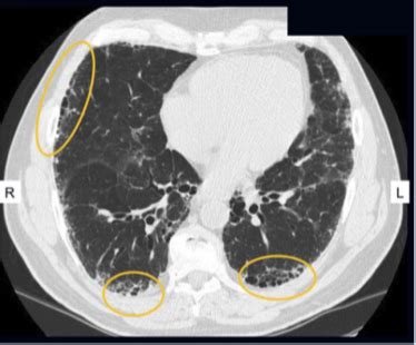 Pulmonology Exam 2 Flashcards Quizlet