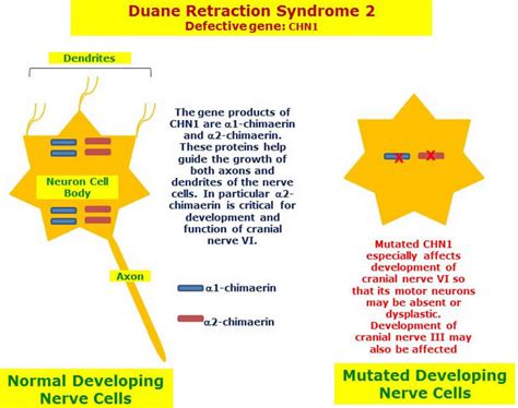 Duane syndrome, Duane Retraction syndrome causes, diagnosis & treatment