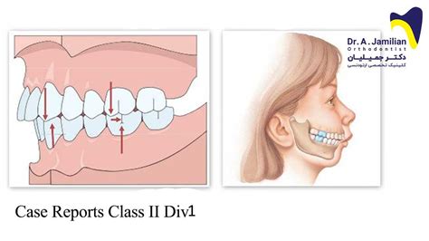 Class I Ii Iii Occlusion Imelda Santana