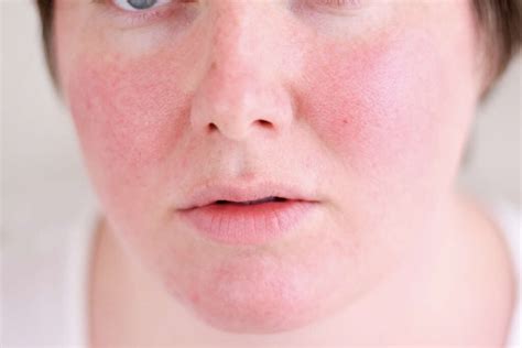 Heat Rash: 10 Heat Rash Symptoms