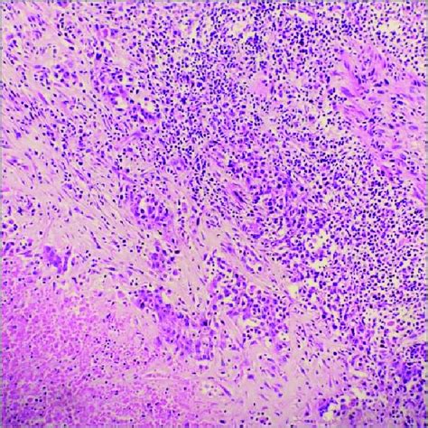 Hematoxylin And Eosin Stained Cell Block Section Shows Syncytial Tumor