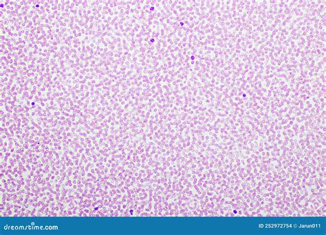 Red Blood Cells and White Blood Cells in Blood Smear Stock Photo ...