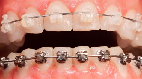 Diferencias Entre Brackets Met Licos Y Zafiro Space Clinic