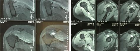 Decompression At The Suprascapular Notch Arthroscopic Landmarks And