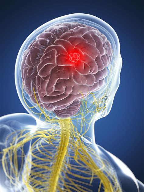 Overview of Headaches from a Brain Tumor