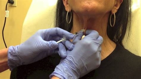 Botox For Platysmal Bands On Neck Youtube