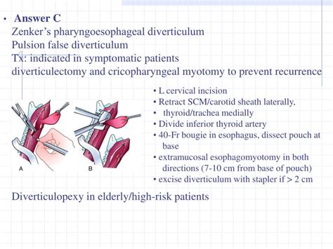 PPT A Diverticulectomy And Myotomy B Myotomy Alone C