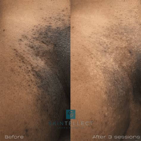 Pubic Full Brazilian Laser Hair Removal Before And After Photos