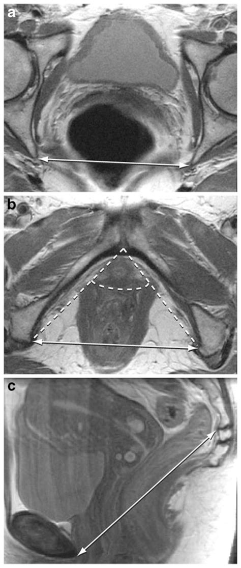 A Axial Pelvic Magnetic Resonance Imaging Mri Slice Demonstrating The