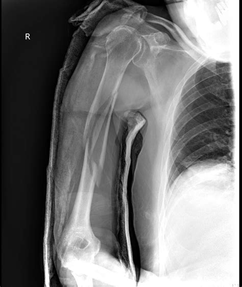 Humeral Shaft Fracture — Kwak Talk