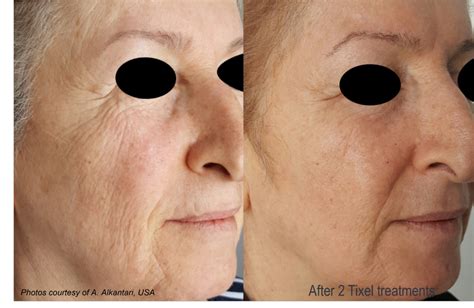 Tixel Before And After Ovation Med Spa