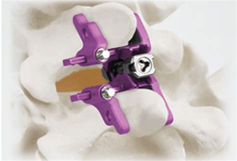 Globus Medical Launches First Expandable Interspinous Fixation Aerial