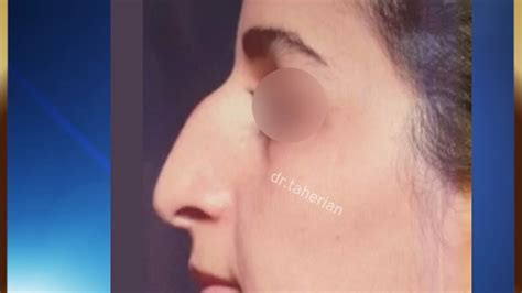 عمل بینی با انحراف و افتادگی زیاد نماشا