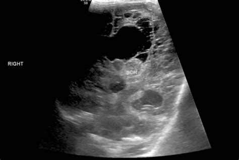 Grade Iv Germinal Matrix Hemorrhage With Periventricular Leukomalacia