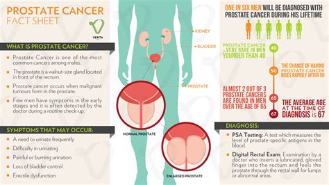 Talking To Your Doctor About Early Stage Prostate Cancer: What Do You ...