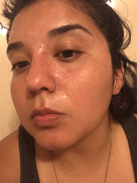 Picked up my metronidazole cream today -really hoping this helps with