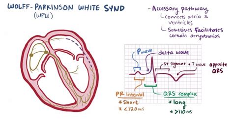 Wolff Parkinson White Syndrome Causes Complications