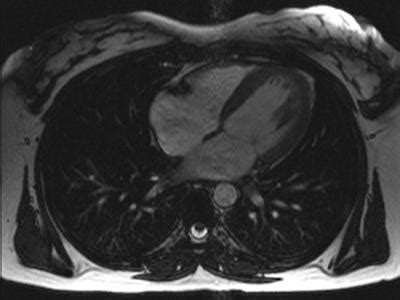 Magnetic Resonance Imaging MRI Cardiac Heart