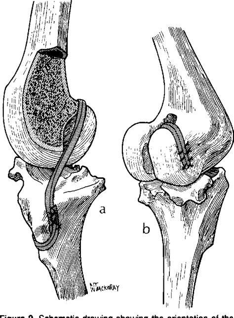 Figure 2 From In Vitro Fibroblast Seeding Of Prosthetic Anterior