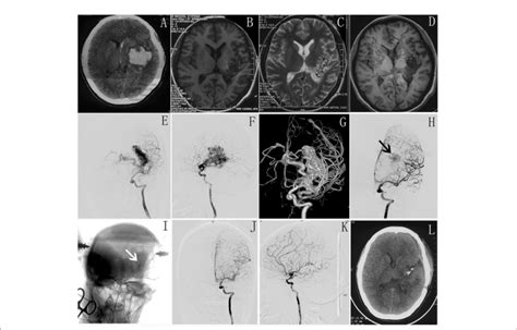 FIGURE E (A) Preoperative CT shows intracranial hematoma in left basal ...