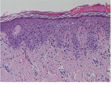 Histology Of One Of The Skin Lesions Epidermal Hyperplasia With