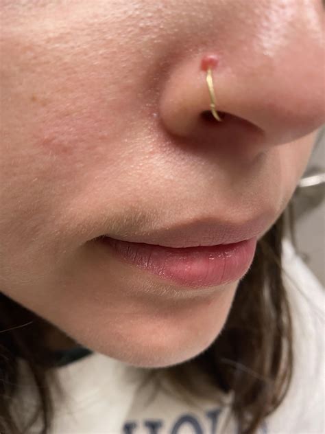 Need Help With Irritation Bump R Piercing