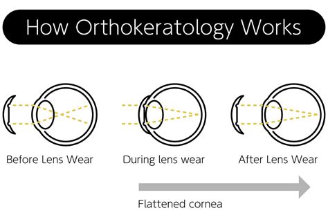 How Does Orthokeratology Work Specialty Eye