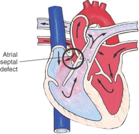 Pediatric Cardiology Flashcards Quizlet