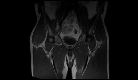 Soft tissue sarcoma MRI | Radiology article on Soft tissue sarcoma MRI