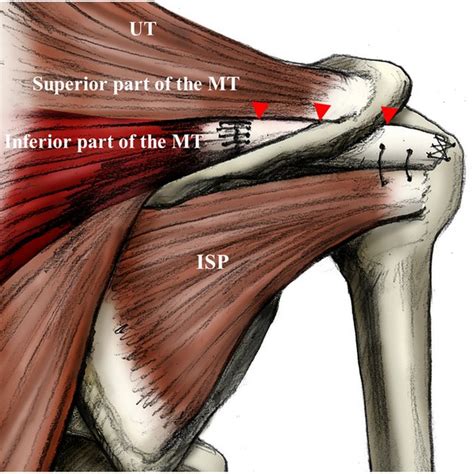 Fascia lata autograft harvest and preparation. A The patient is placed ...